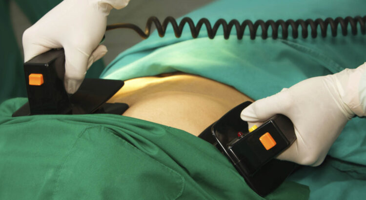 Doctor using a defibrillator at hospital