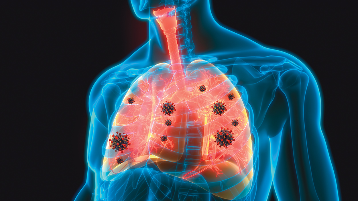 The X-VENT: Breathing Life Into Critical Technology - HealthTrust ...